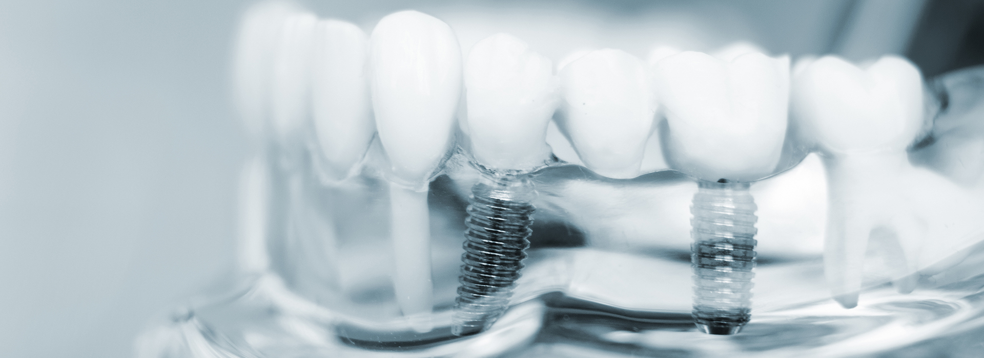 The image displays a close-up view of dental implants with screws visible against a blurred background.
